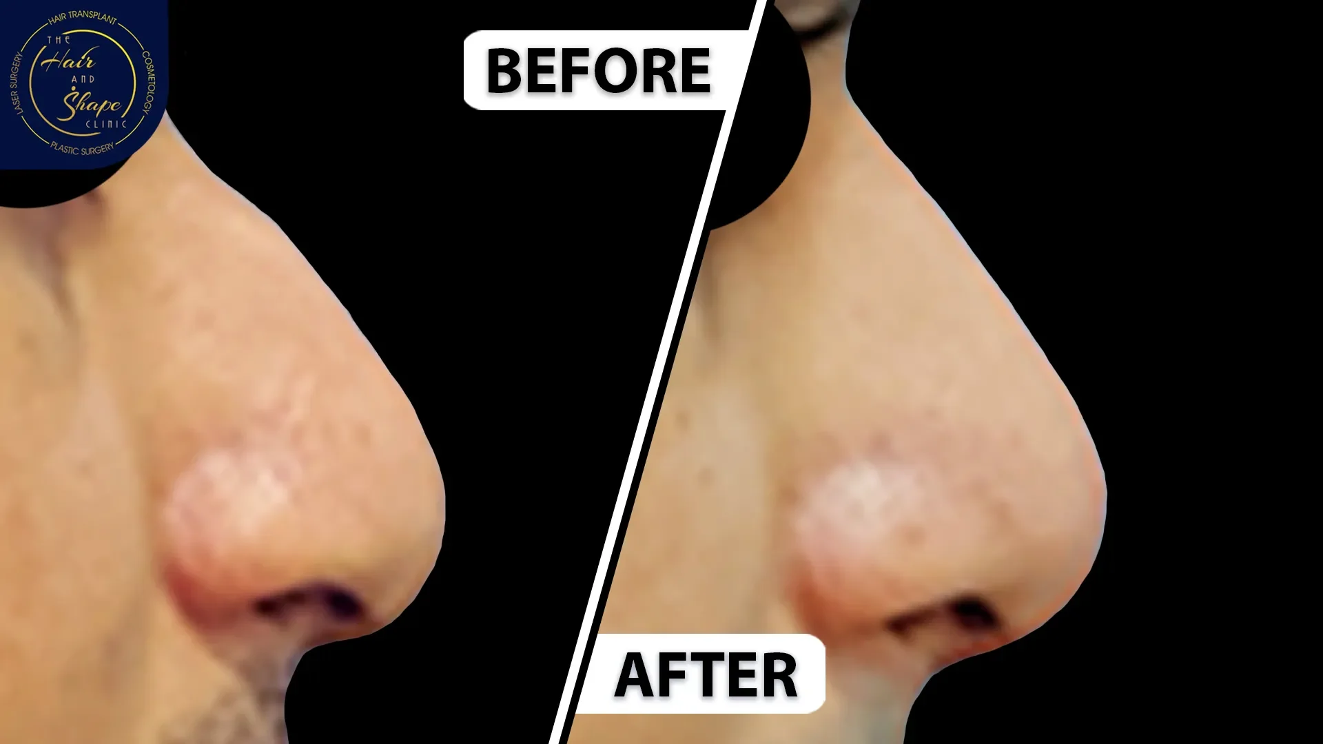 Rhinoplasty result12
